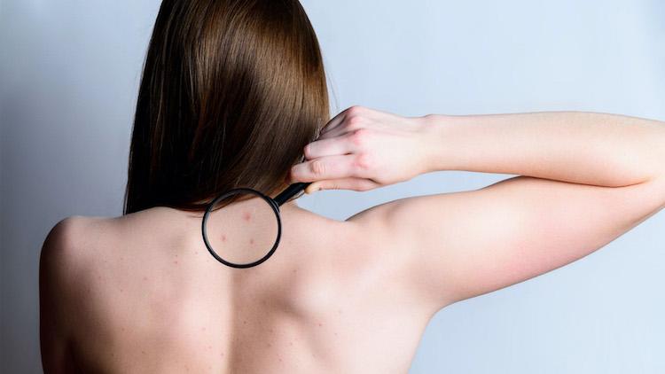 Mụn lưng, nguyên nhân và cách khắc phục mun-lung3